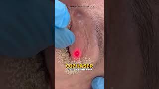 CO2 Laser Treatment in Karachi  #skincare #lasercutting  #lasermachine  #laserengraving