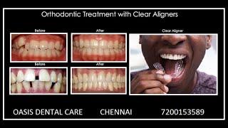 Cost of Invisalign/Invisible Aligner Treatment at Oasis Dental Care - Chennai