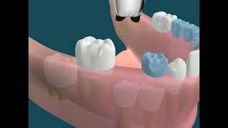 Dental Video for Space Maintainer - The Tooth