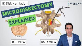 Microdiskectomy: Anatomy, Step by Step Procedure, Risks, Recovery, and Restrictions