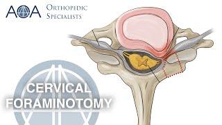 AOA Orthopedic Specialists - Cervical Foraminotomy