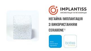 Негайна імплантація з використанням cerabone® – результат через 8 років