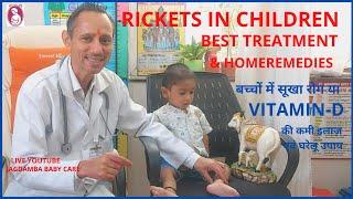 RICKETS IN CHILDREN BEST TREATMENT & HOMEREMEDIES,बच्चों में सूखा रोग VITAMIN -D की कमी इलाज़ नुस्खे