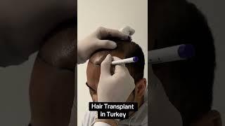 Hair Transplant in Turkey | Hair Transplant Process  #hairtransplantturkey