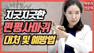 (*Eng) 편평사마귀 치료법, 관리법, 레이저 제거 Flat warts removal - 피부과전문의 [닥터필러]