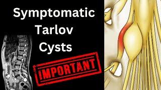 Symptomatic Tarlov Cysts: An Overlooked and Dismissed Spine Condition