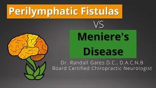 Perilymphatic Fistulas vs Meniere's Disease