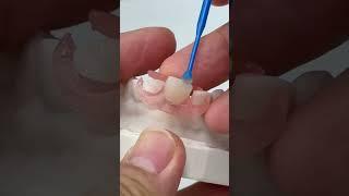 Single tooth option!