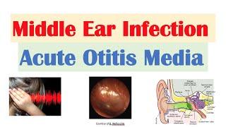 Middle Ear Infection (Acute Otitis Media) | Causes, Symptoms, Diagnosis, Treatment