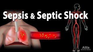 Sepsis and Septic Shock, Animation.