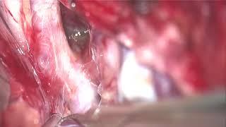 Clip reconstruction of ruptured PCom and ICA aneurysm