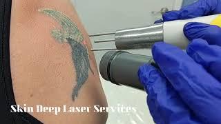 Laser Tattoo Removal on Shoulder at Skin Deep Laser Services in Northern VA, Burke, VA