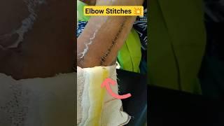 Dressing Removal After Elbow Surgery #elbow_pain #elbowsurgery #elbowpain #fracture #bone #elbow