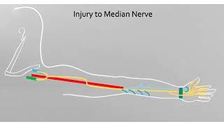 Upper Limb with Chimmalgi: Median Nerve