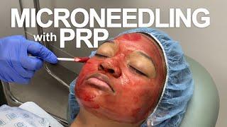 Microneedling with PRP | West End Plastic Surgery