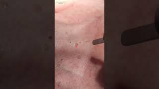 Seborrheic Keratosis #shortvideo #shorts