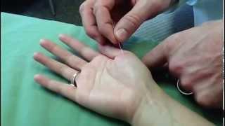 Master Tung's Neck & Shoulder Pain (Xiaojie) Brad Whisnant -- Online PDA Acupuncture