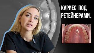 Кариес под ретейнерами после снятия брекетов️