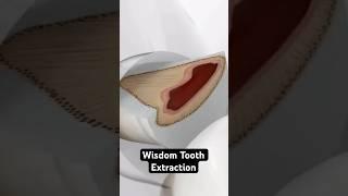 Wisdom Tooth Extraction (3D Animation)