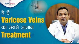 ये है Varicose Veins का सबसे आसान Treatment