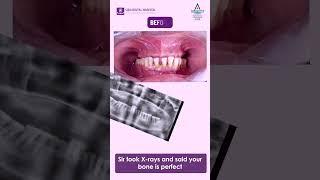 Patient Feedback | Best Dental Implants in Hyderabad | Best Dental Hospital | Siri Dental Hospital