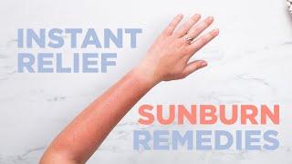 Instant Relief Sunburn Remedies