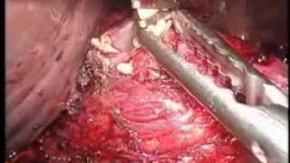 Laparoscopic Retrieval of Foreign Bodies: 3 Cases