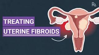 Uterine Fibroids: What Are the Symptoms and Treatment Options?