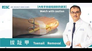 拔趾甲 Toenail Removal | 拔趾甲手術 | 嵌甲 | 甲溝炎 | 凍甲 | 皮膚專科醫師張英睿 【內有手術過程請斟酌觀賞】