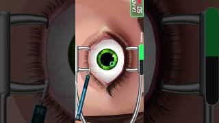 عملية تصحيح البصر بالليزر #عمليات_جراحيه #جراحة #العين #مشفى #طبيب #طب #الطب #trending