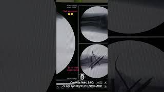 dr v n singh mbbs d ortho #successfull #oprationsindoor #mbbsprivatecolleges #mdadmission #doctor