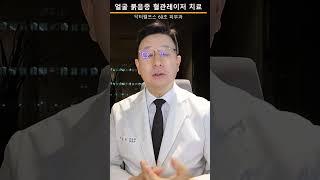 얼굴의 붉음증(안면 홍조) 혈관레이저를 이용한 치료 #홍조 #엑셀브이
