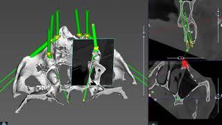 Pterygoid Implant Positioning