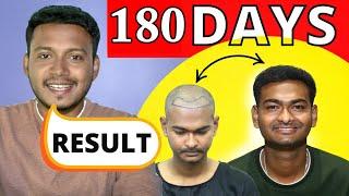 Understanding Hair Transplant Results ll 6 Months Experience With 2700 GRFATS