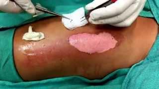 Dr Arthur performing burn wound debridement and surgical preparation #burn #burns #burnsurgery