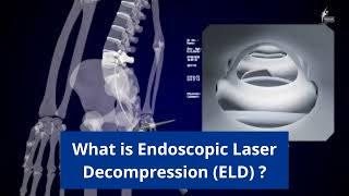 Endoscopic Laser Decompression (ELD) - Minimally Invasive Treatment for back and neck pain