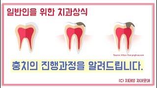 치과상식 | 충치의 진행과정을 알려드립니다. | VLOG 치대생 브이로그_치아모아