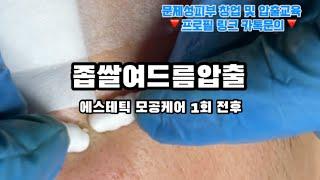 좁쌀 여드름 압출, 에스테틱 모공케어 1회 전후