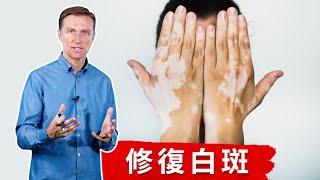 (皮膚7) 白斑,3種營養素, 斷食提升免疫力.自然療法,柏格醫生 Dr berg