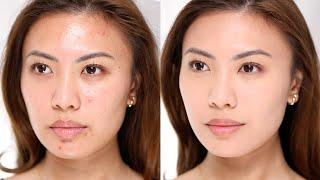 How to cover acne *NO FOUNDATION MAKEUP*