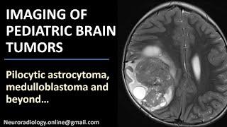 Imaging of Pediatric Brain Tumors