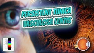 Persistent tunica vasculosa lentis - Your EYEBALLS - EYNTK ️️