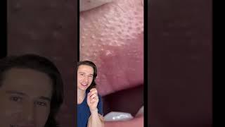 Blackhead Removal #dermreacts