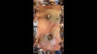 Blackhead Removal | 18 | Blackhead extraction | #blackheads