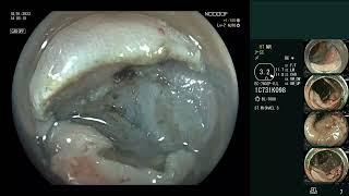 TC EFTR Resection + Closure