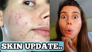 SKIN UPDATE || WHY DO I HAVE ACNE ON MY CHEEKS!! My Naturopath, Probiotics, Digestion, what's next..