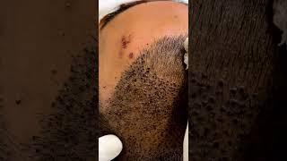 40M+ Views | It’s not just a regular head wash | Hair Transplant Clinic in Delhi