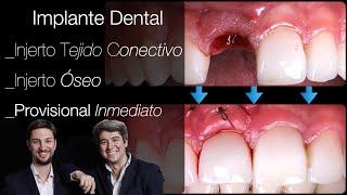 Implante dental Paso a Paso: Diente fijo en 1 hora. Implante dental con Injerto conectivo y de hueso