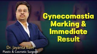 Gynecomastia Marking & Immediate Result | Dr. Jayanta Bain Plastic & Cosmetic Surgeon