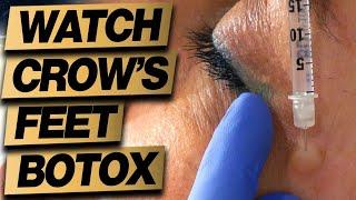 Botox Eyes Crows Feet Treatment Technique: 2 Easy Steps